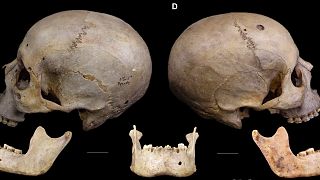 The 4,000-year-old skull bears traces of what could be the earliest cancer treatment ever.